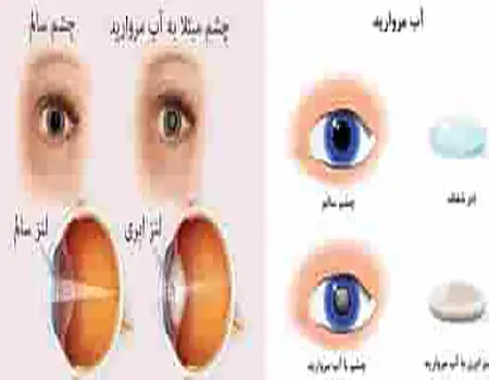 جراحی آب مروارید چشم